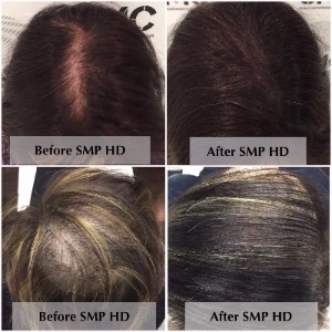 Scalp Micropigmentation in Women