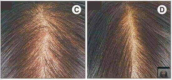 Fractional Laser Hair Growth