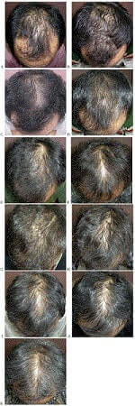 Ten Years Finasteride Hair Loss Treatment Before After.