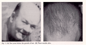 Hair Regrowth in Old Man