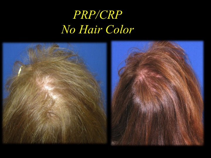 Grey Hair Reversal PRP