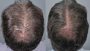 PRP hair growth and hair color pigment change.
