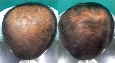 Dutasteride Indian Hair Loss Patient
