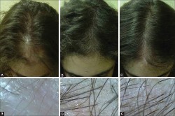 PRP Hair Loss Results