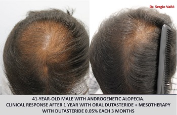 Dutasteride Mesotherapy Before and After