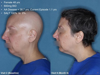 Aclaris JAK Inhibitor Alopecia Areata Before and After Photo