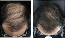 Botox Hair Growth Before After