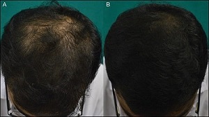 Botox for Hair Growth
