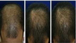 ADSC-CE Before and After Hair Growth.