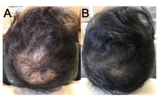Redensyl, Capixyl and Procapil Hair Growth Treatment