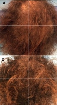 Micrograft Stem Cell Transplant Hair Growth Before After -- Pietro Gentile