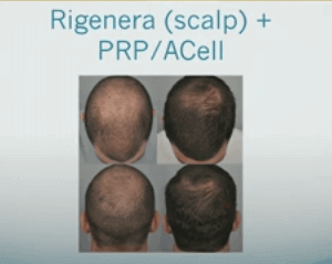 Regenera Activa AMT for Hair Loss | Hair Loss Cure 2020