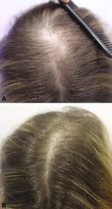 Bicalutamide Female Pattern Hair Loss