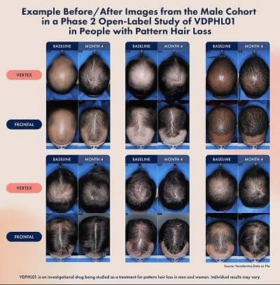 Veradermics VDPHL Hair Growth