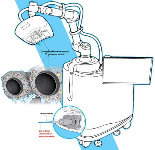 HAIRO Hair Transplant Robot