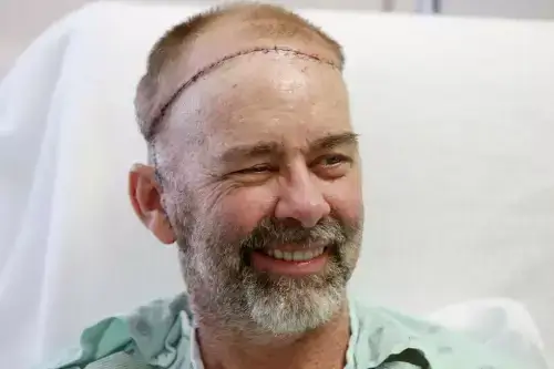 Jim Boysen Before Skull and Scalp Transplant.